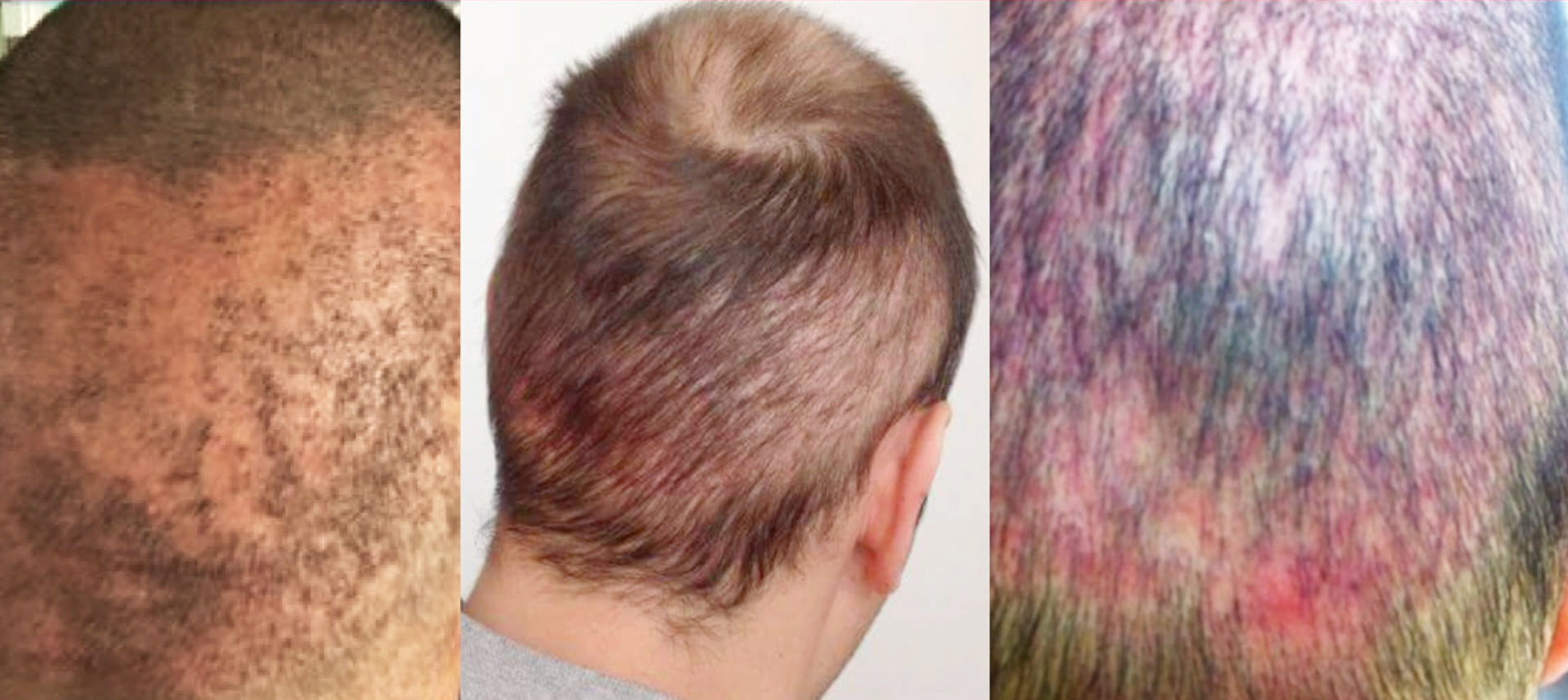 Beware Illegal Hair Transplant - Fight the Fight