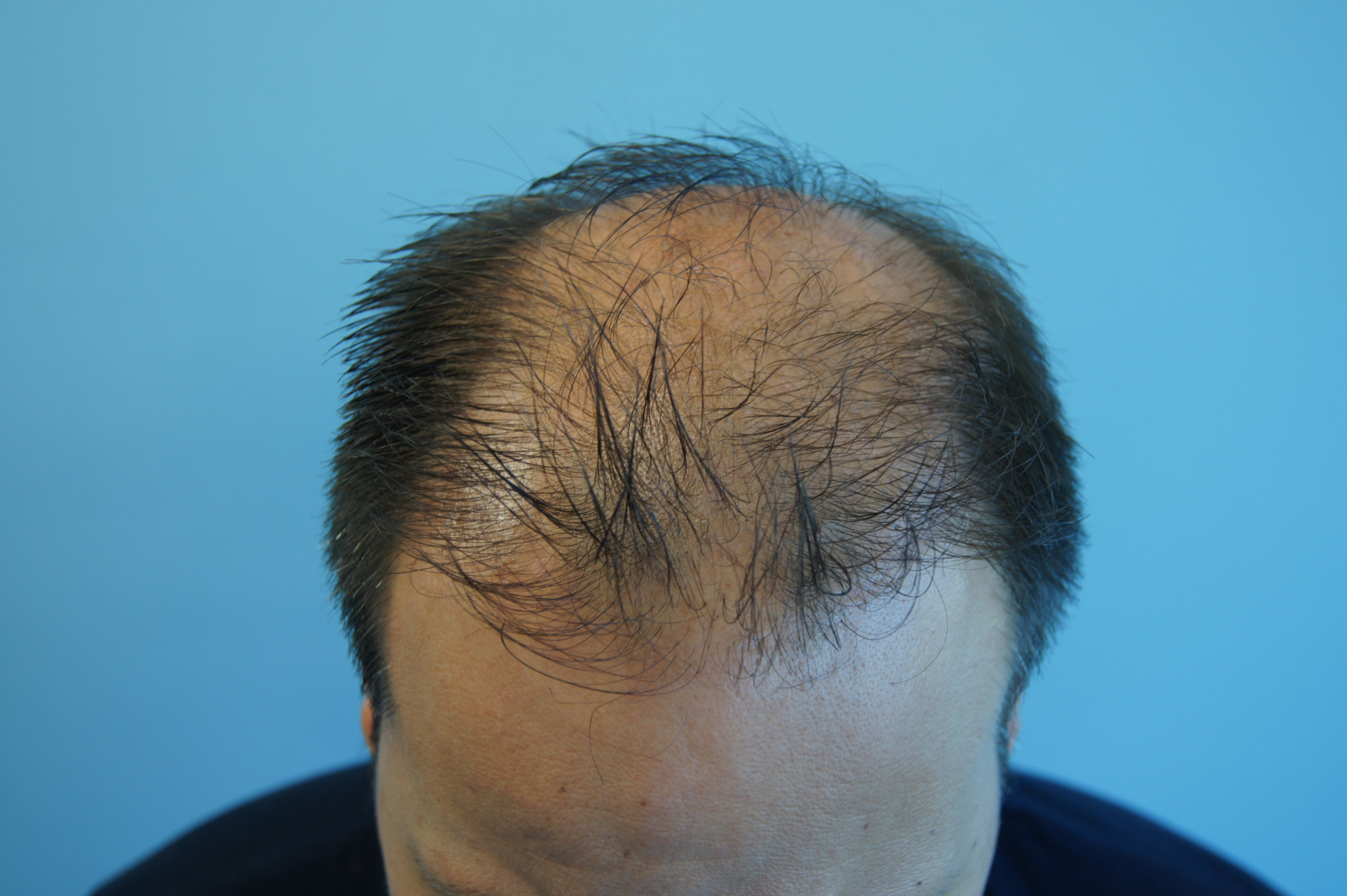 What Happens When a Cheap Hair Transplant Goes Wrong Fight the Fight