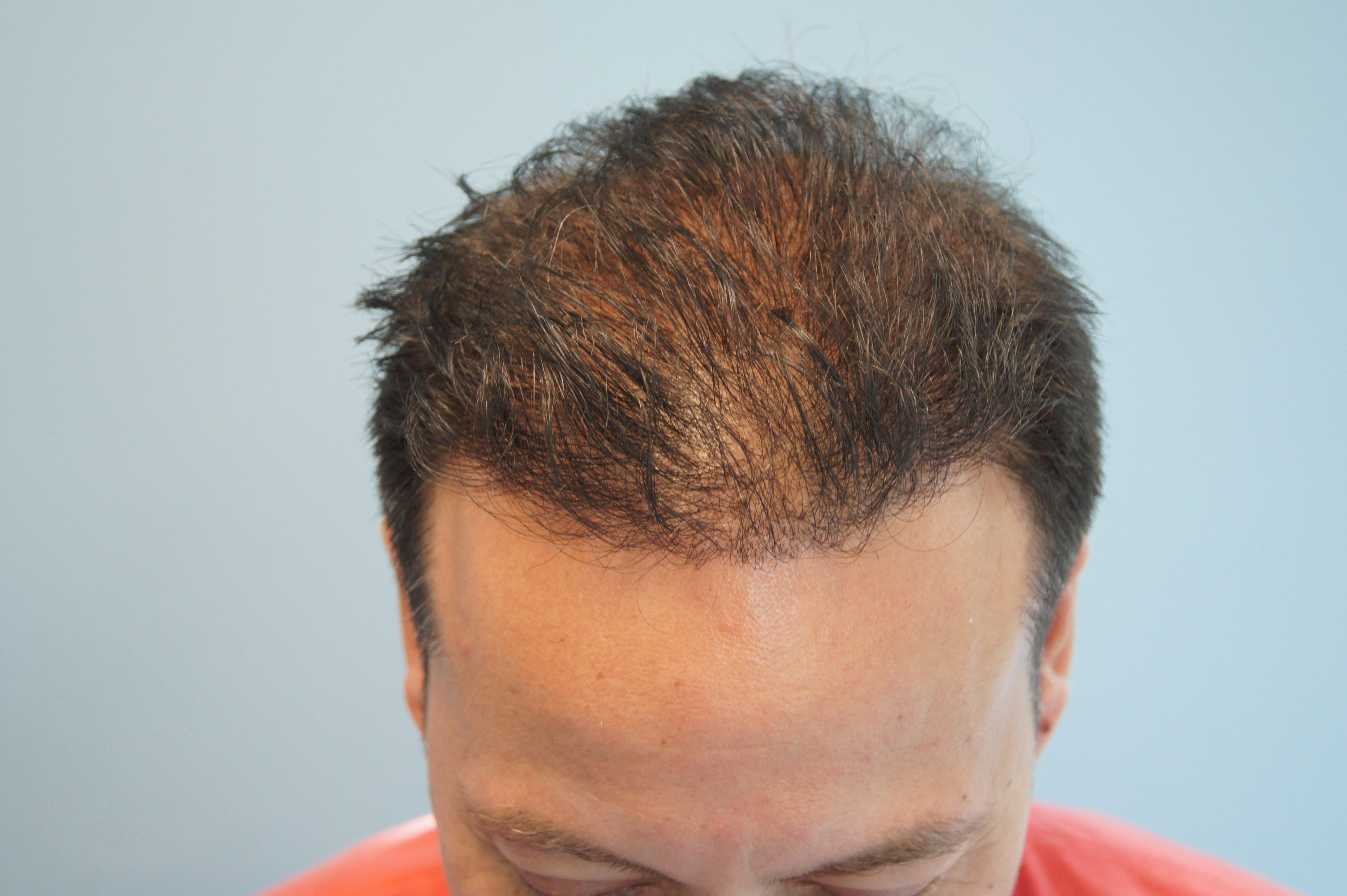 What Happens When a Cheap Hair Transplant Goes Wrong Fight the Fight