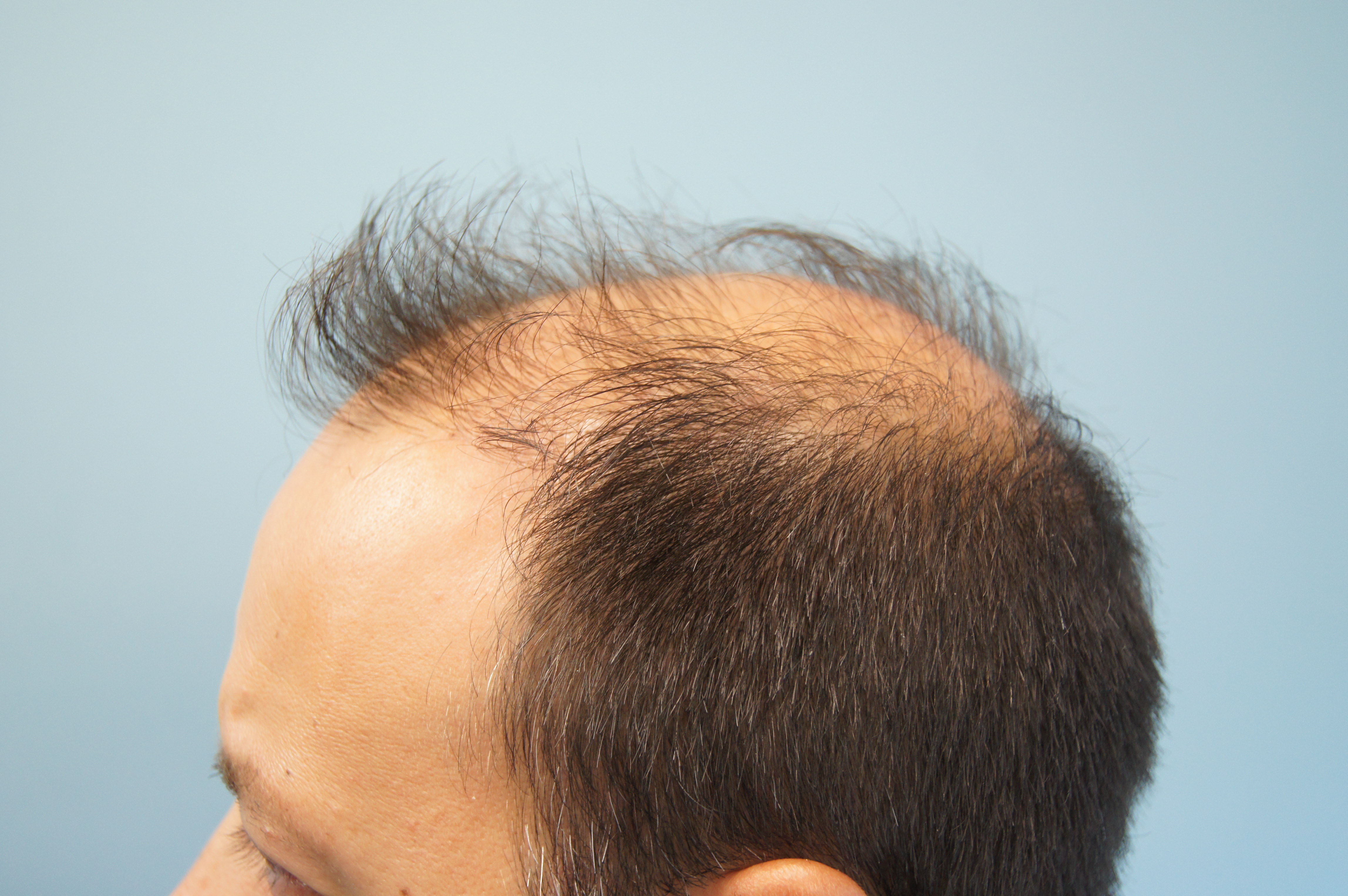 What Happens When a Cheap Hair Transplant Goes Wrong Fight the Fight