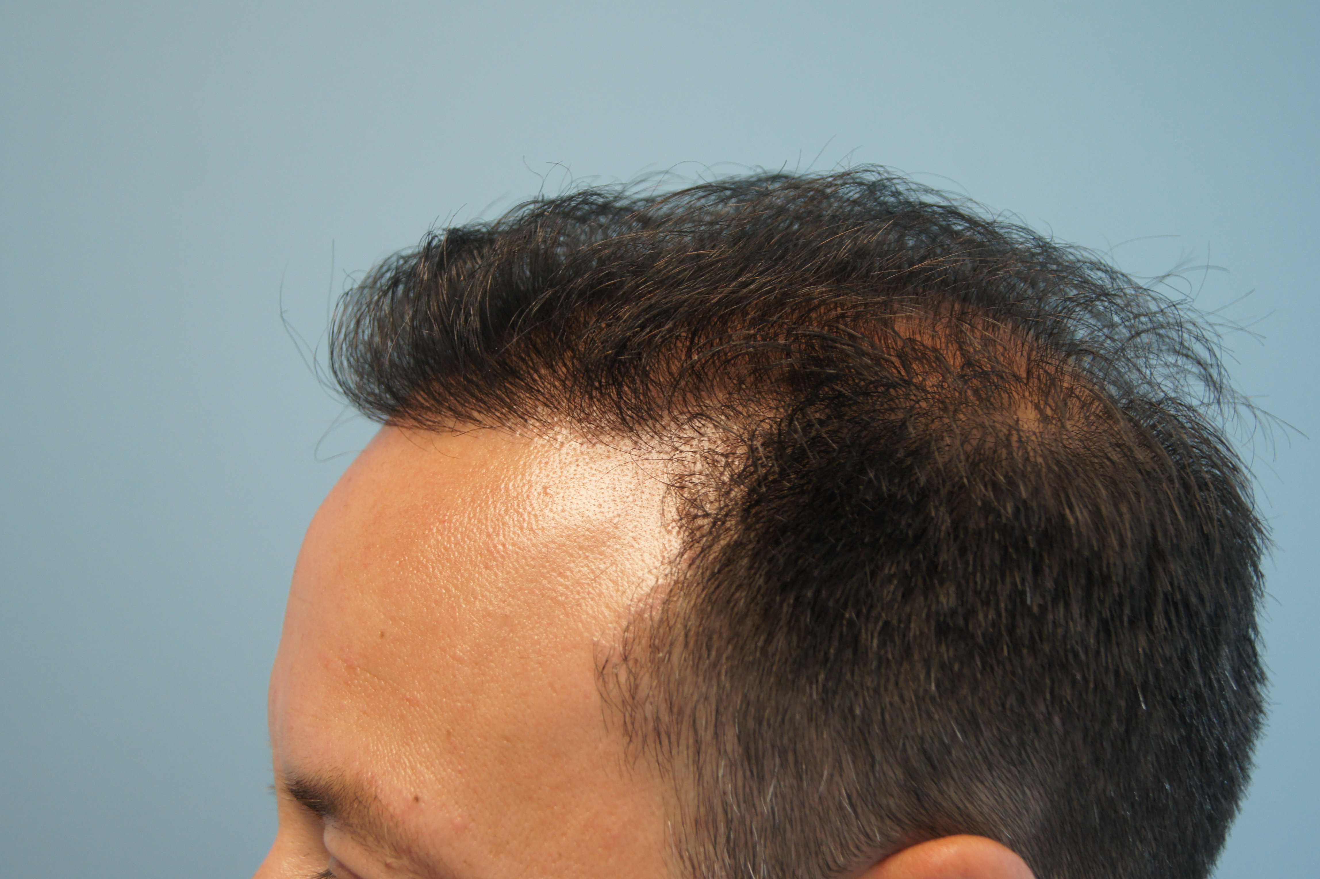 What Happens When a Cheap Hair Transplant Goes Wrong Fight the Fight