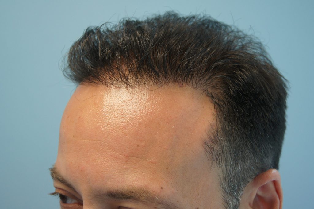 What Happens When a Cheap Hair Transplant Goes Wrong - Fight the Fight