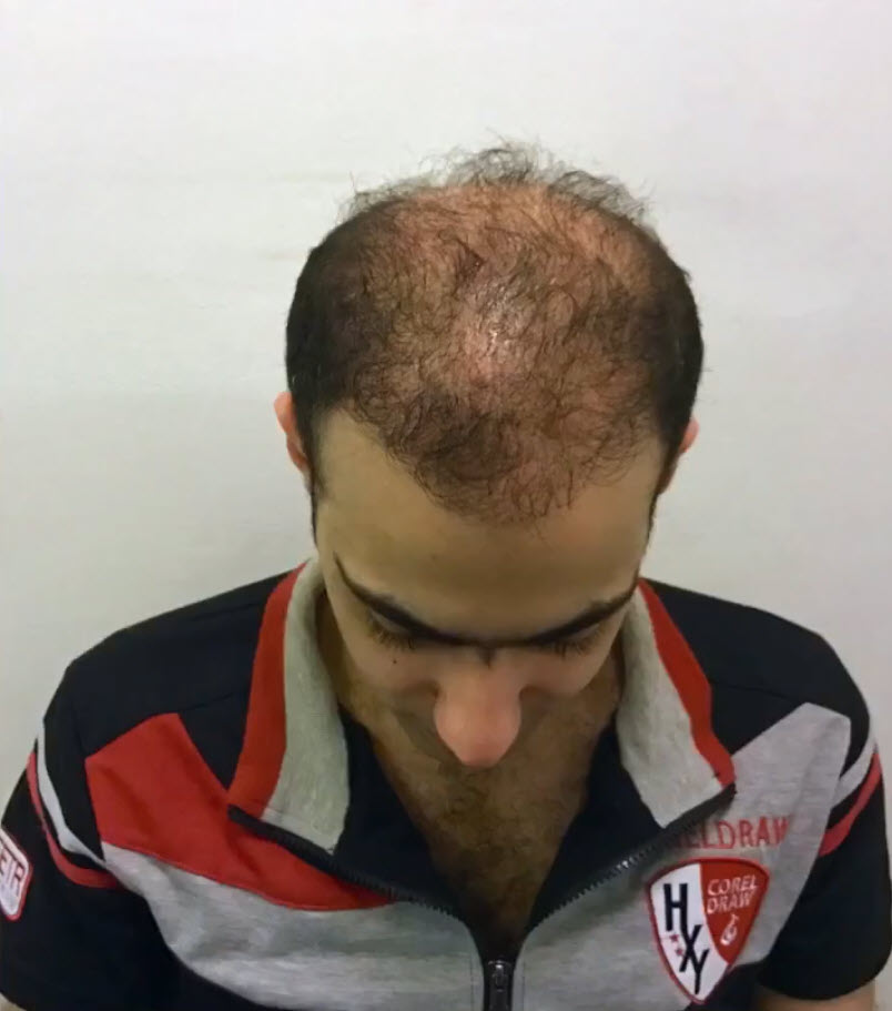 Are Hair Transplants Worth It?, Wimpole Clinic