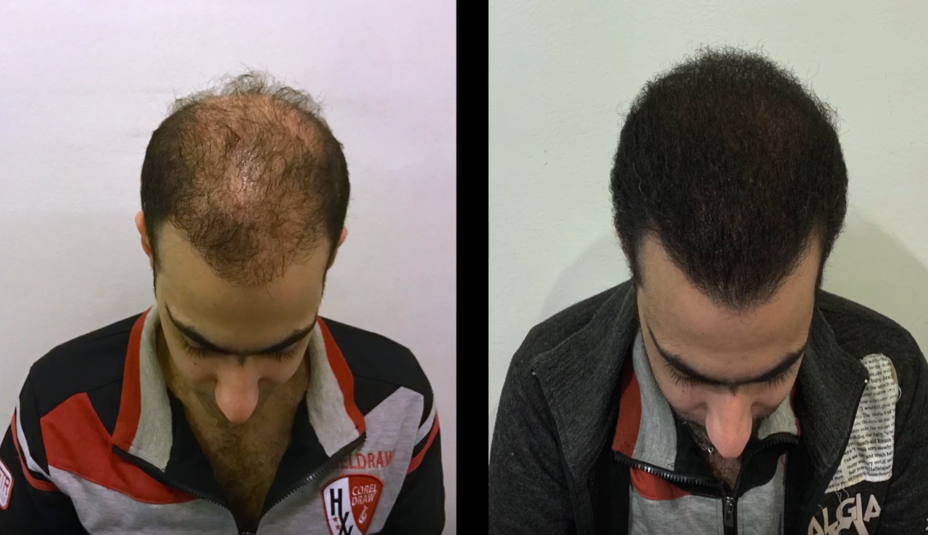 Patient Shares Story of Bad Hair Transplant In Turkey - Fight the Fight