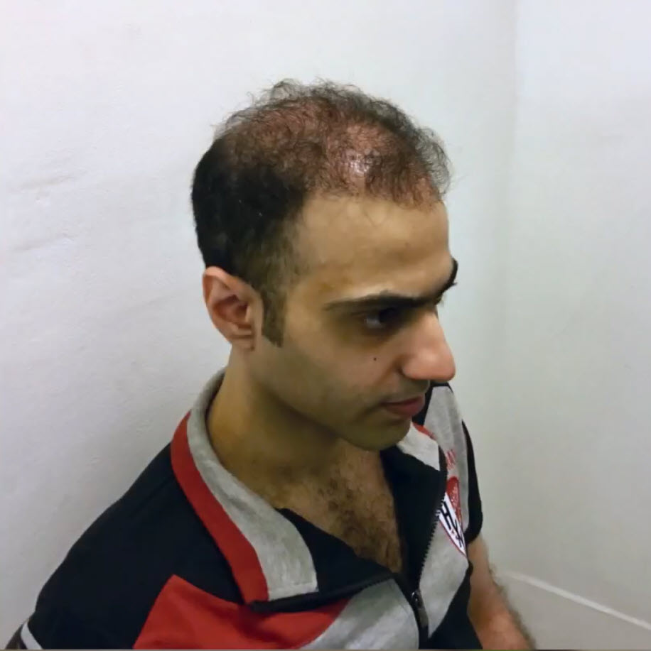 Hair Transplant Recovery Timeline From Day 1 to 12 Months  EasyHairHub