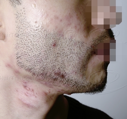 Folliculitis and acne following a beard transplant gone wrong in Turkey