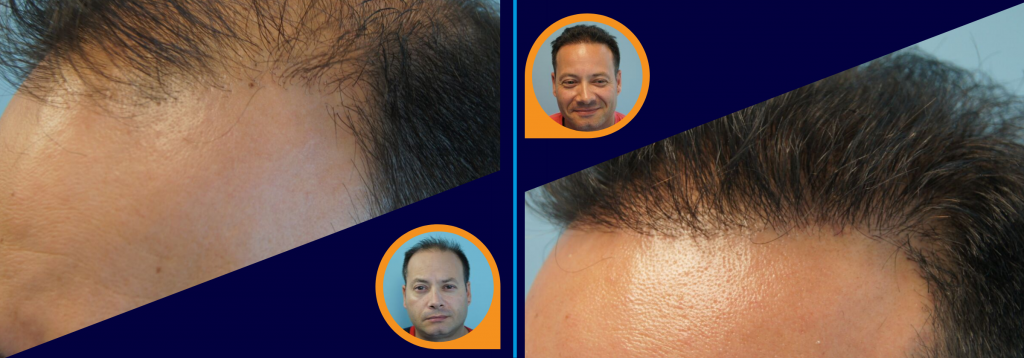 What Happens When a Cheap Hair Transplant Goes Wrong - Fight the Fight