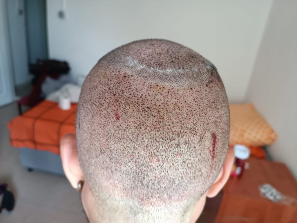 Example of an over-harvested hair transplant