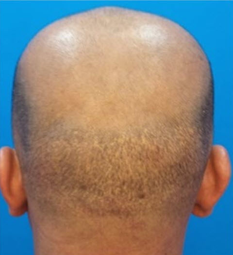 overharvested hair transplant ghost clinic