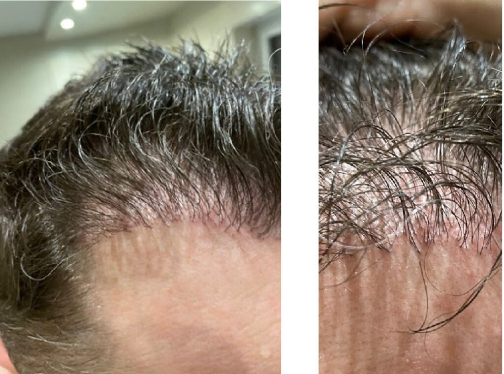 1 year after hair transplant turkey