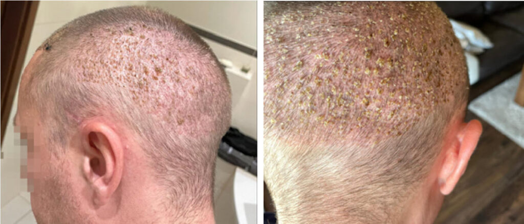 3 weeks after hair transplant surgery