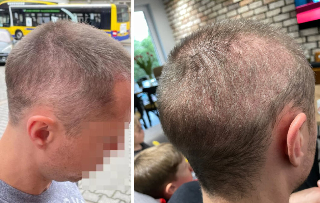 5months after hair transplant overharvested hair