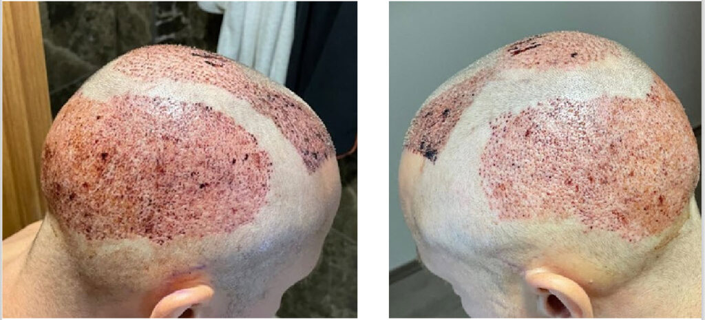 after hair transplant turkey