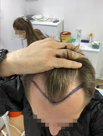 before hair transplant illicit clinic