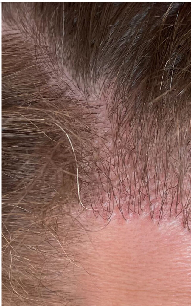 hair transplant results 1 year black market