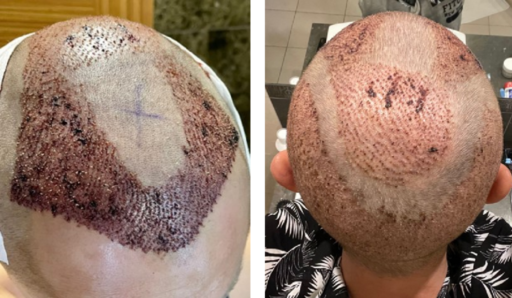 one week after hair transplant surgery turkey