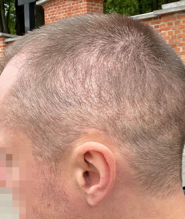 overharvested donor area hair transplant