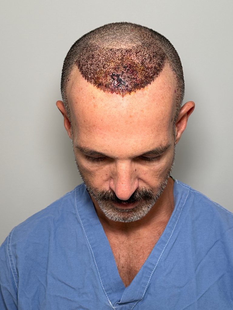 Patient's face chin down. Necrosis on the scalp