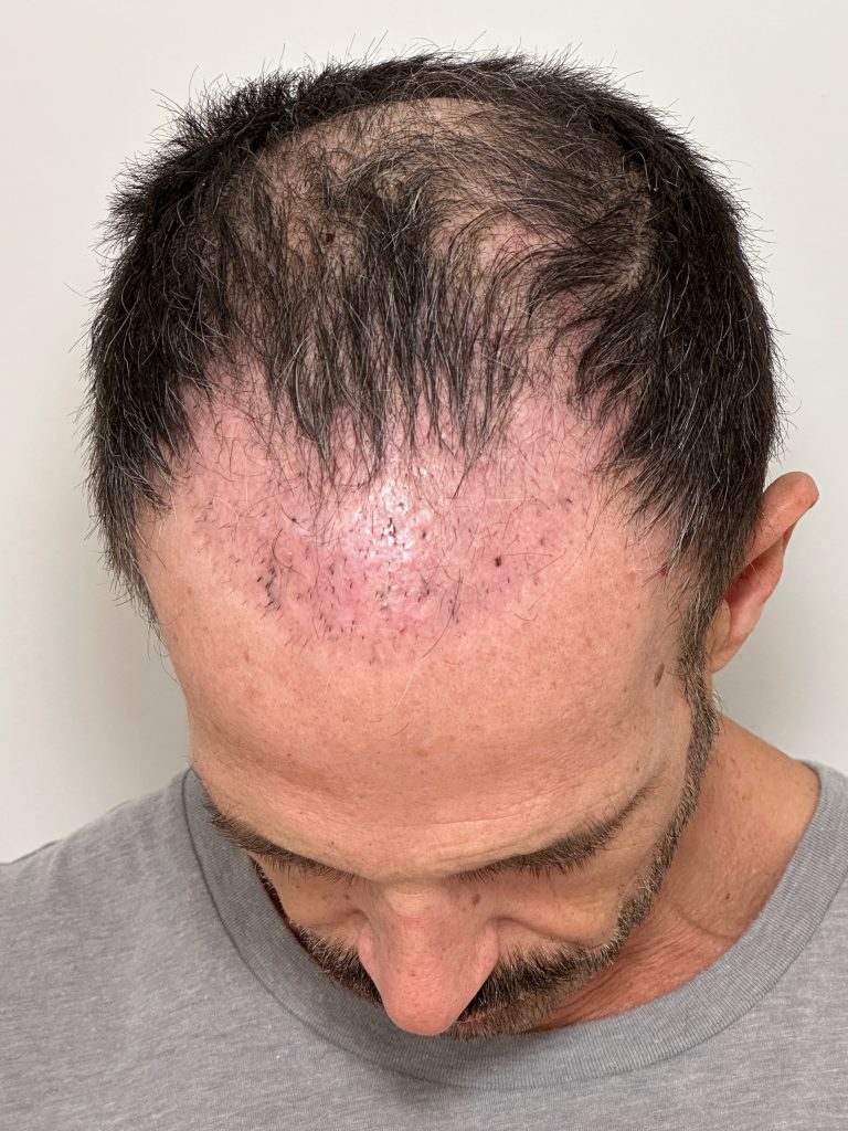 Hair implants lost due to scalp necrosis.