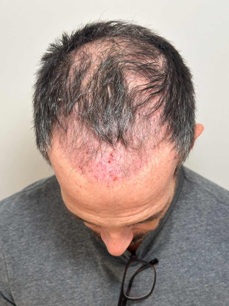 Hair implants lost due to scalp necrosis.