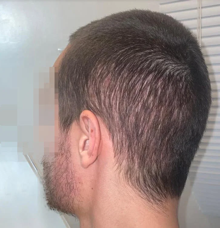 marché noir de la greffe de cheveux