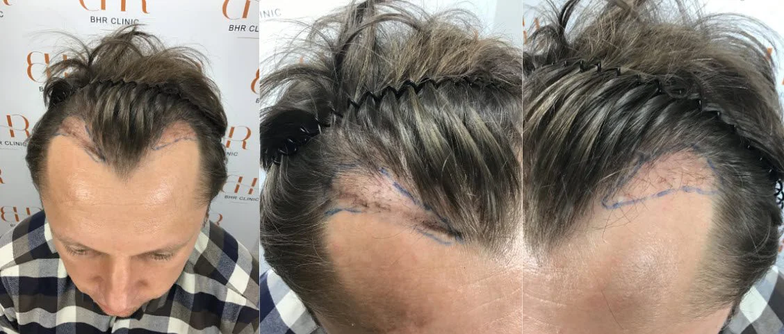 14months after hair transplant repair