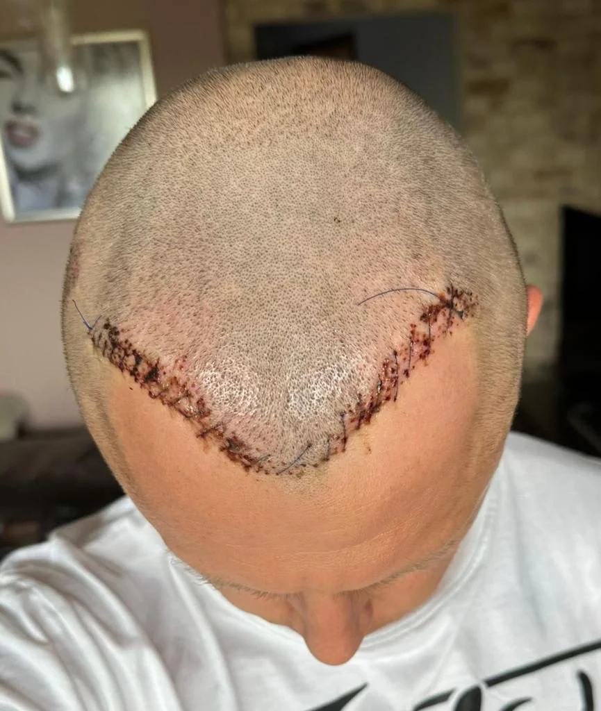after hair transplant repair