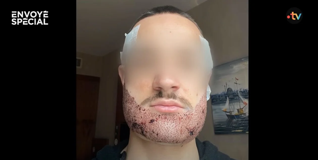 botched beard transplant