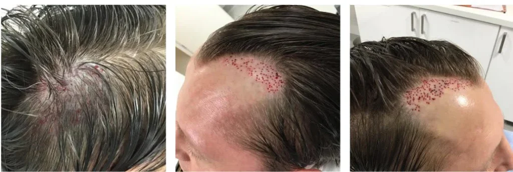 final removal placing grafts