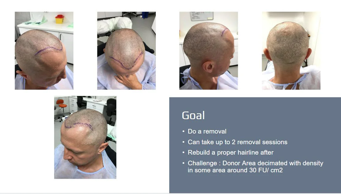 hair transplant repair