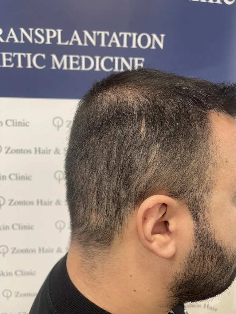 6 months results right