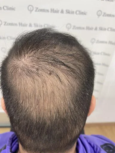 donor area depletion back