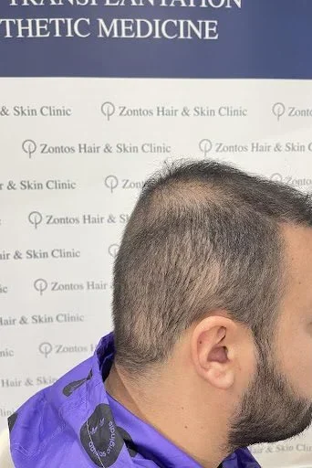 donor area depletion right