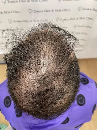 recipient area depletion