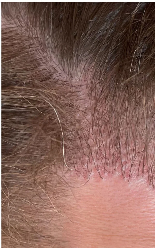 hair transplant results 1 year black market
