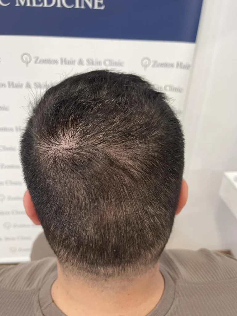 one year results back